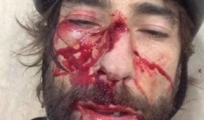Vittorio Brumotti cade dalla bici: ferito al volto