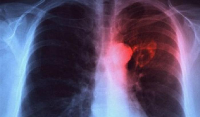 Tumore: temperatura del respiro per scoprirlo