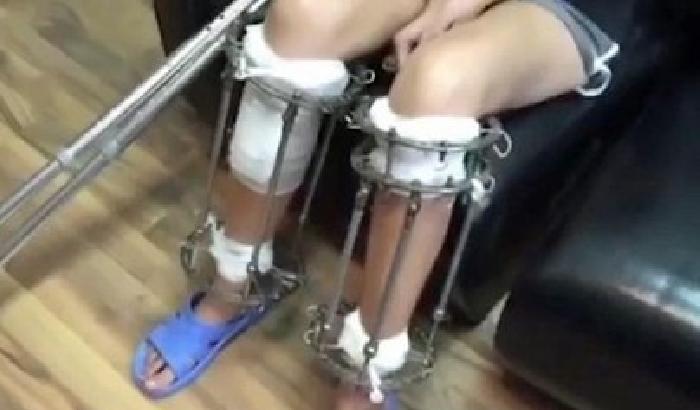 Vuole fare la modella: si opera per crescere 6 centimetri