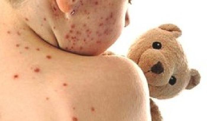 Nel 2013 il morbillo ha fatto pi&ugrave; morti dell&rsquo;Aids