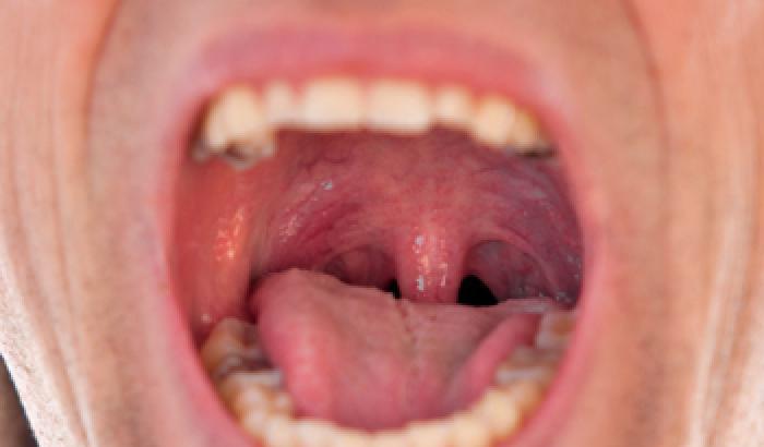 Il sesso orale provoca tumori alla gola