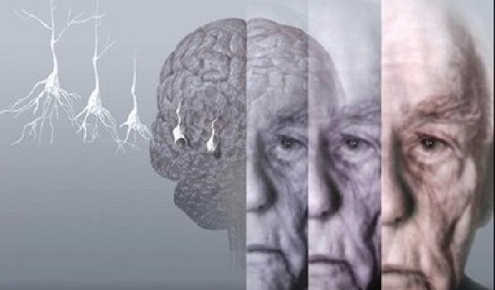 Uno studio italiano rivela la spia per l'Alzheimer precoce