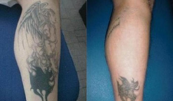 Ecco come cancellare un tatuaggio in modo sicuro