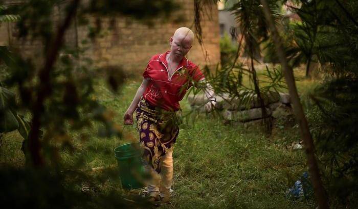 Una delle abitanti dell'Isola degli albini in Tanzania