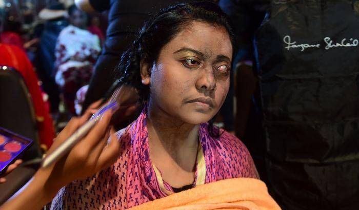 La ragazza sfregiata con l'acido