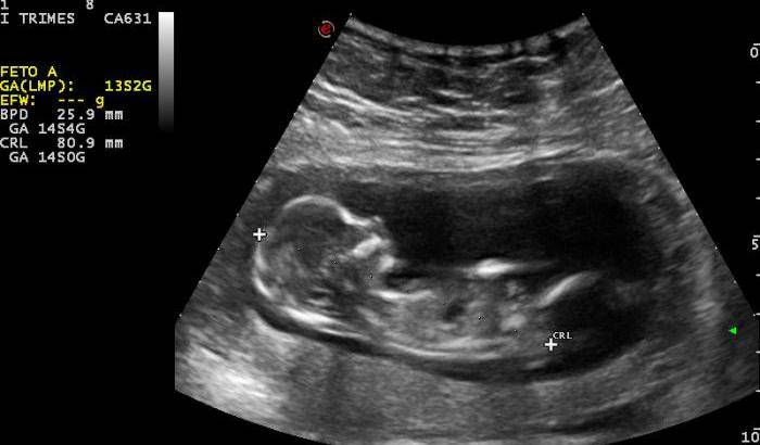 Aborto: in Texas i medici potranno mentire alle madri sulle malattie del feto
