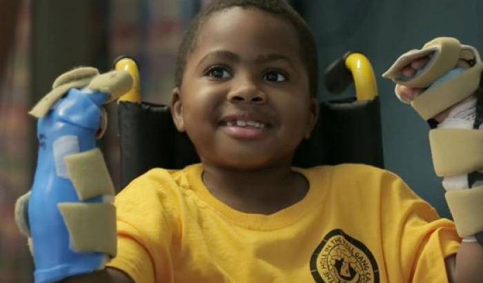Zion Harvey, il primo bambino su cui i medici hanno eseguito un doppio trampianto alle mani