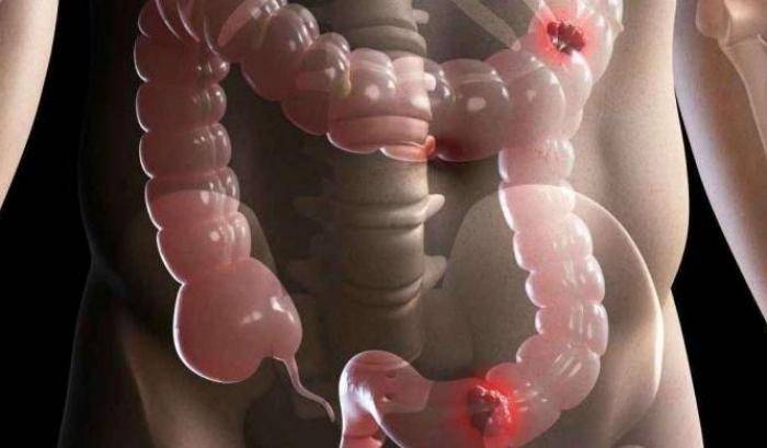 Creati dei batteri intestinali che battono il tumore al colon-retto