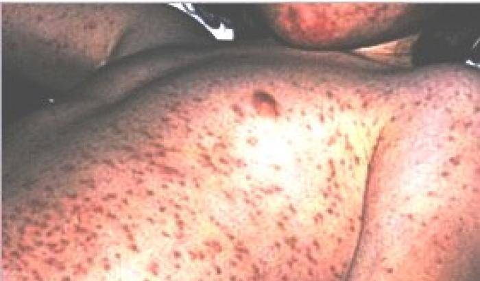 Algeria: il morbillo fa strage di bambini, dieci morti negli ultimi giorni