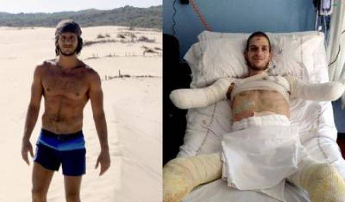 Gambe e braccia amputate per una meningite fulminante: lo sportivo Davide come Bebe Vio