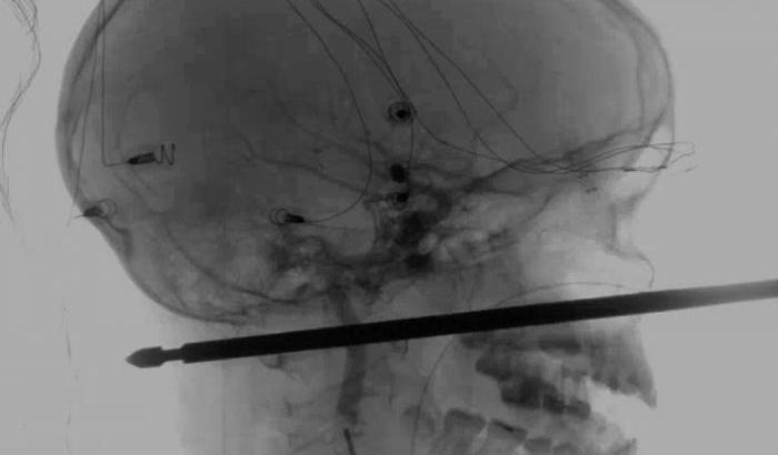 00050153-il-cranio-trapassato-da-uno-spiedino Il cranio trapassato da uno spiedino
