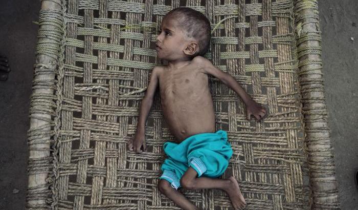 La guerra e la fame in Yemen hanno ucciso 85.000 bambini