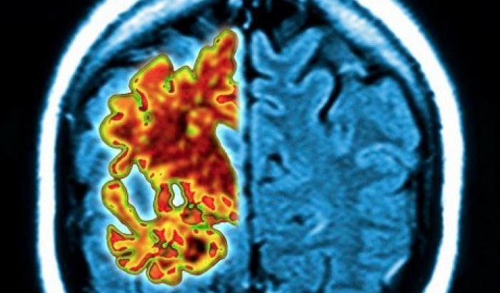 Usa, sperimentato un nuovo metodo per smascherare in anticipo l'Alzheimer