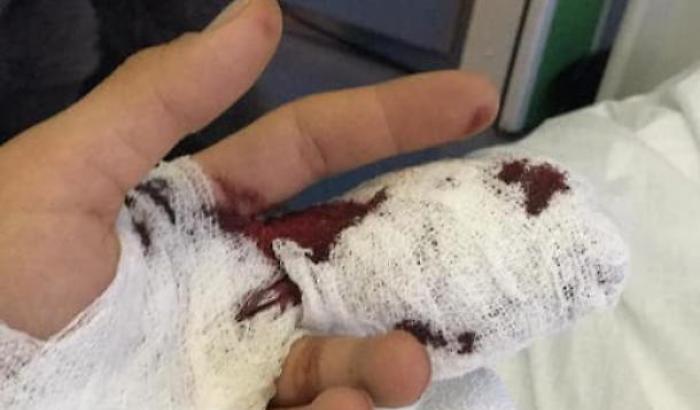 Strappa a morsi la falange di un dito a un poliziotto: arrestato