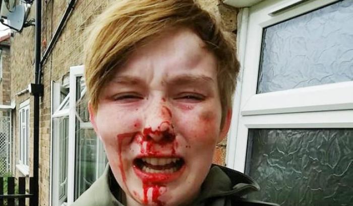 Diciottenne picchiata a sangue in strada da omofobi: "Sei una f*****a lesbica"