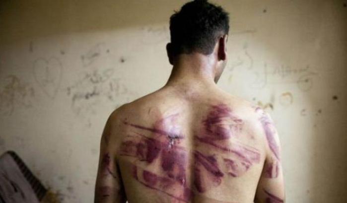 Un oppositore di Assad mostra i segni delle torture