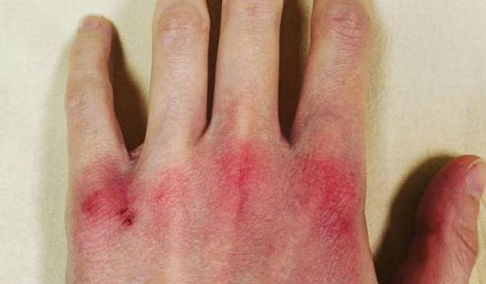 Come lavarsi le mani senza danneggiare la pelle: le regole del dermatologo