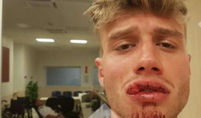 Picchiato a sangue da un poliziotto in borghese, la denuncia di un 23enne romano