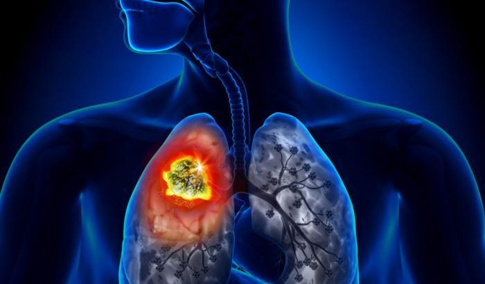 Buone notizie per la cura dei tumori: passo avanti del Cnr per trattare il cancro al polmone