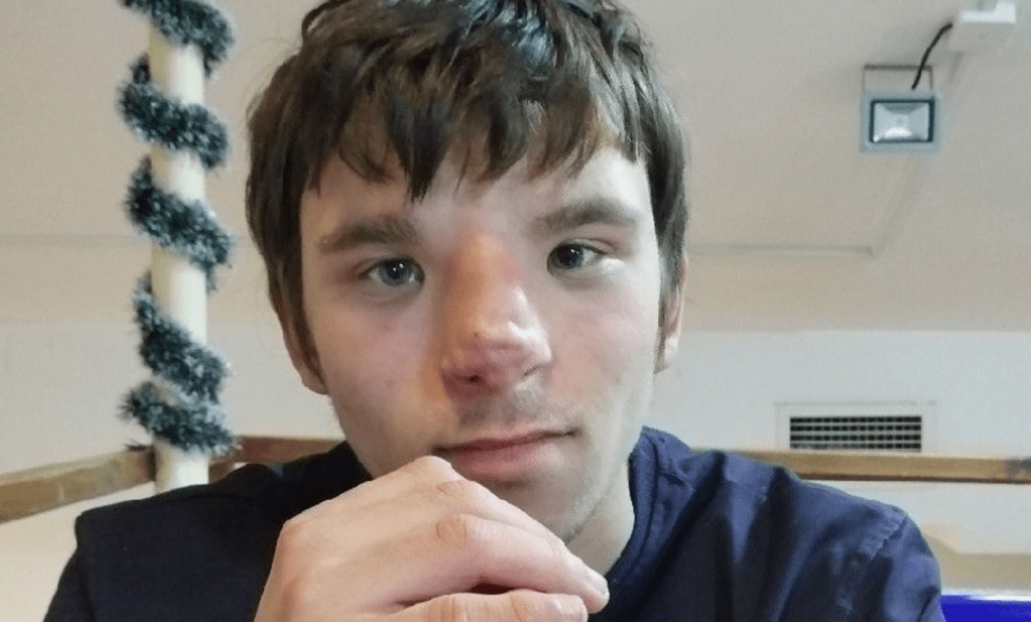 Storia di Anton Fedoseev, soldato di Putin per pagarsi un'operazione alla faccia e morto in Ucraina