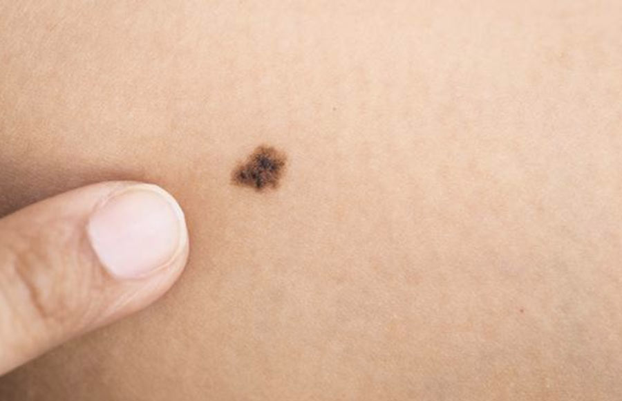 In Italia crescono i casi di melanoma