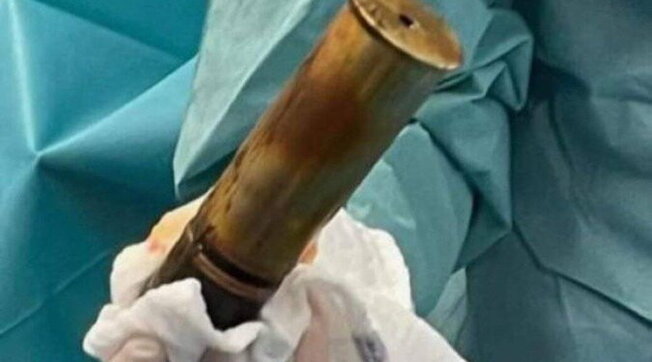 Anziano arriva in ospedale con una bomba nel retto: scatta l'evacuazione in un pronto soccorso a Tolone