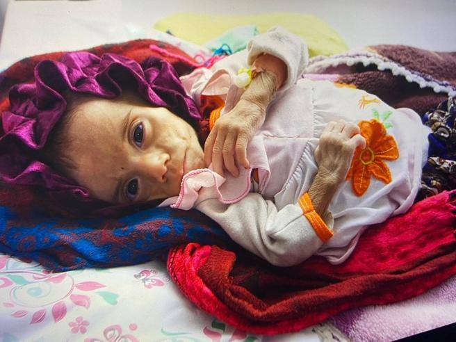 Mai così tanti morti per fame: sono 30 milioni i bimbi malnutriti nel mondo