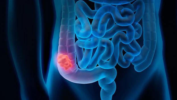 Trovato il punto debole di un tumore al colon che lo rende curabile