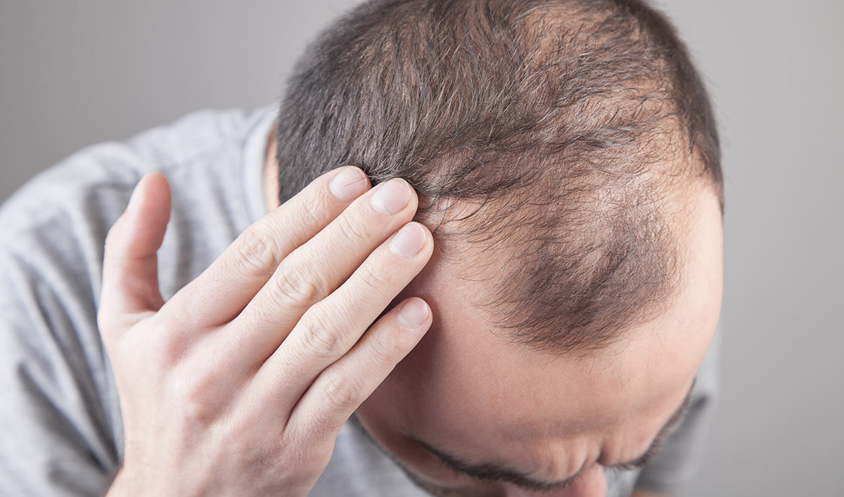 Le principali cause della perdita dei capelli al giorno d'oggi