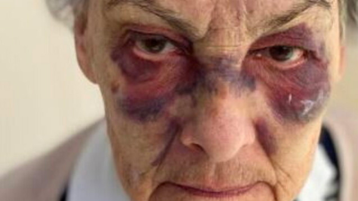 Una donna di 83 anni presa a bastonate da un senzatetto: aveva rifiutato di fargli l'elemosina