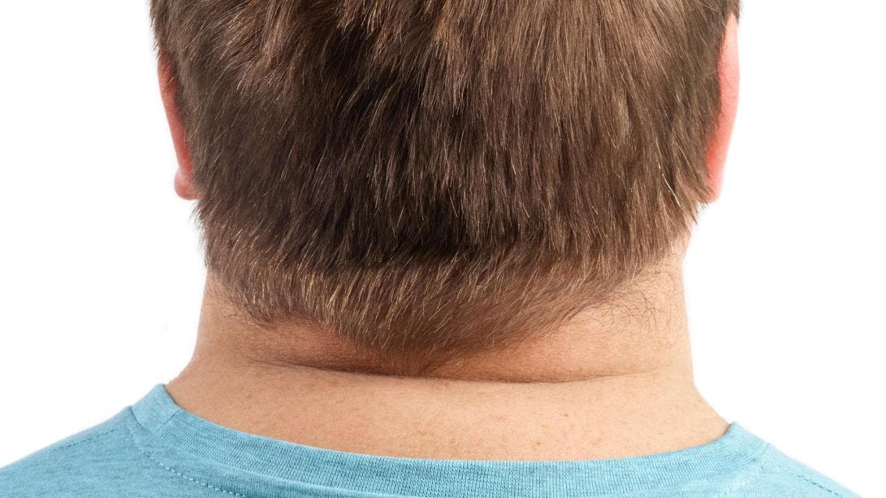 Trapianto di capelli: perché il risultato non può essere immediato?